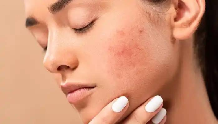 Skin Care – Pimples Problem