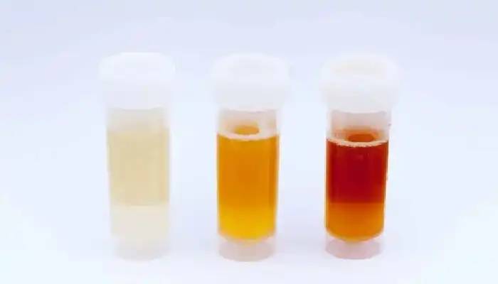 Urine Colour And Its Meaning